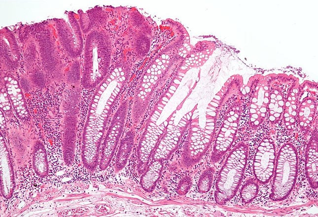 Benign or Malignant: Can You Identify These Colonic Lesions?