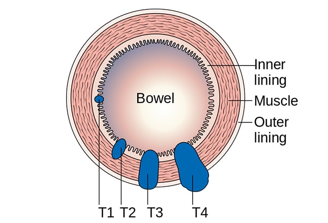 Colorectal Cancer: Prevention, Diagnosis, and Therapeutic Options