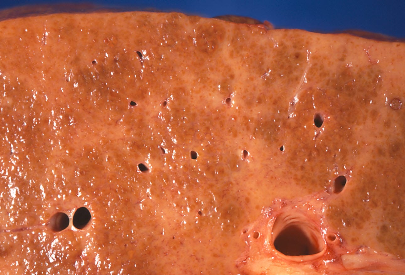 Alcohol Abuse Complications And Consequences