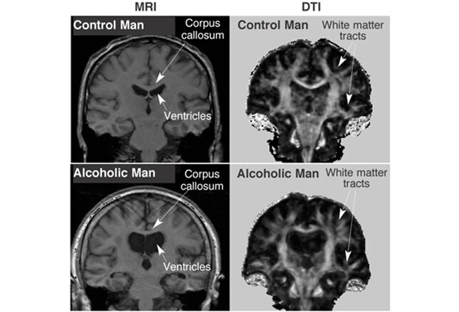 Chronic Alcohol Abuse: Complications and Consequences