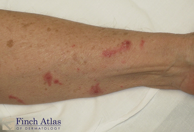 Contact Dermatitis An Overview