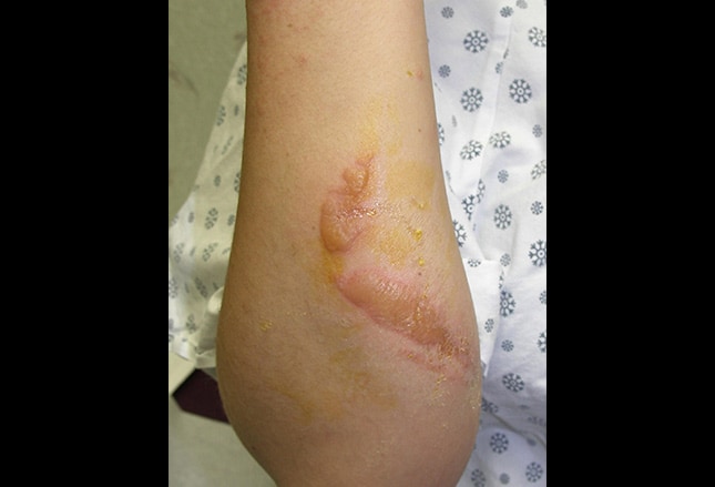 Contact Dermatitis: An Overview