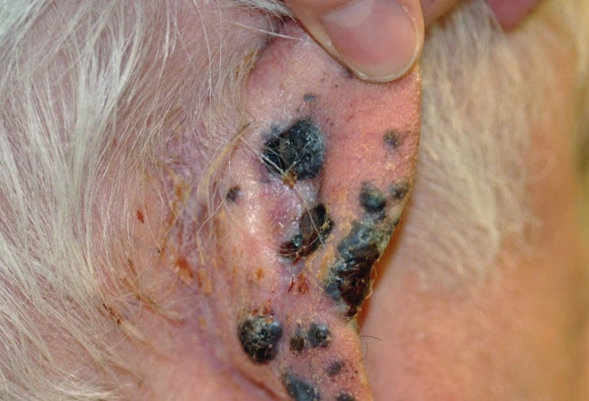 Deadly Skin Cancers   Fig3 