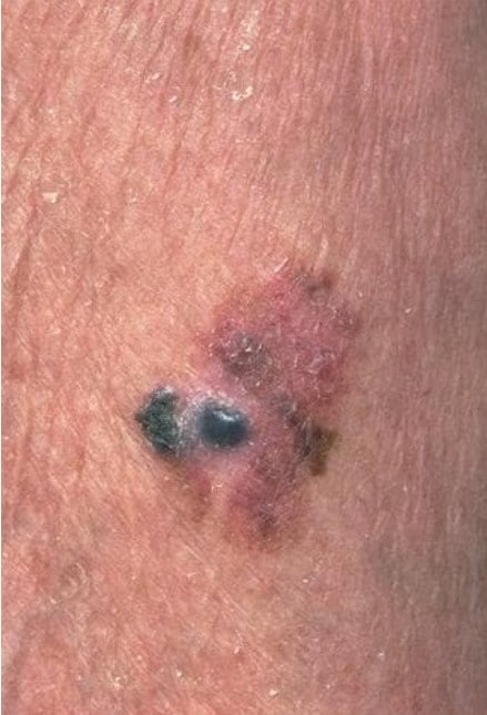 Deadly Skin Cancers