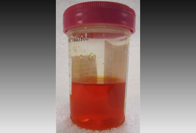 overview-and-classification-of-discolored-urine-cause-of-discolored