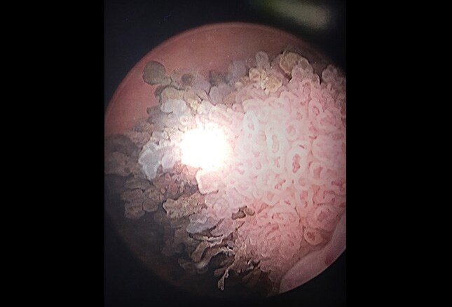 microscopic hematuria图片