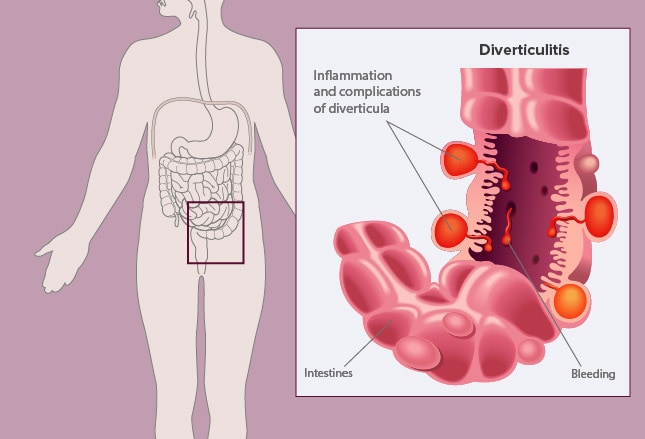 Diverticulitis and it's complications