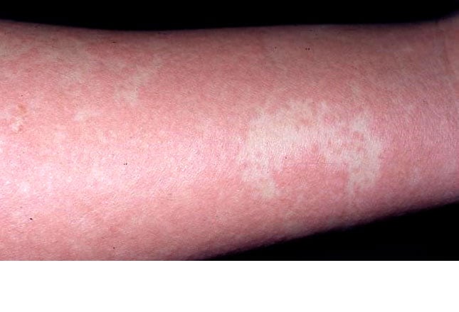 Drug Reaction Skin Rash