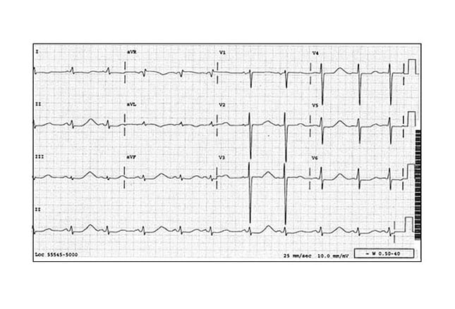 7 Can'tMiss LifeThreatening ECG Findings