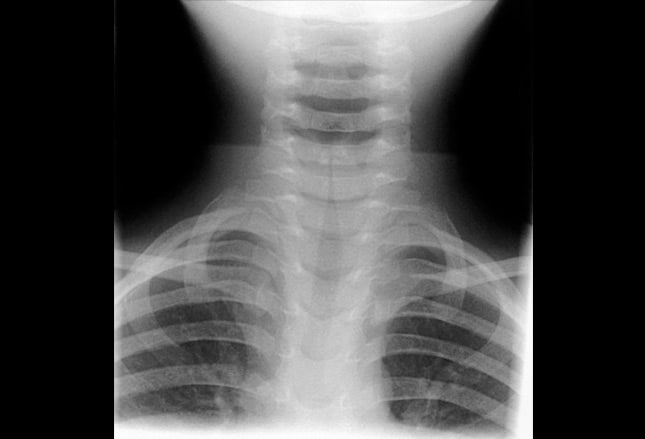 Which Condition Causes A Steeple Sign On X-ray? Emergency Airway Management: 3 Challenging Populations