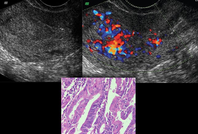 endometrial-cancer-common-but-predominantly-curable