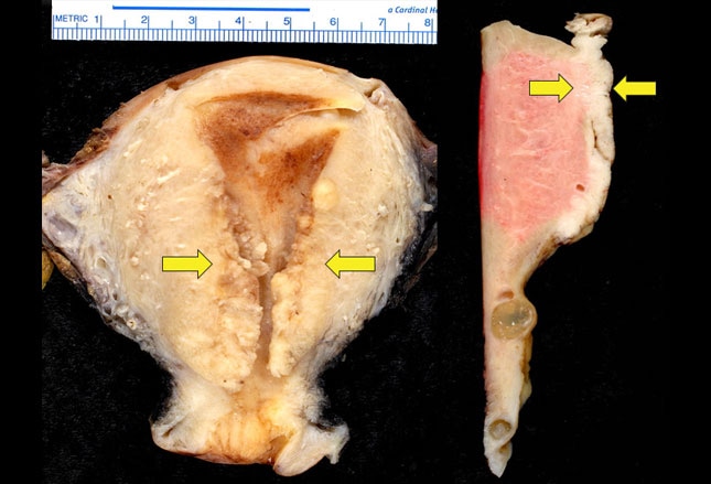 Stage 2 Uterine Cancer