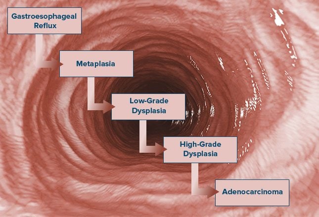 Image result for picture of esophageal cancer