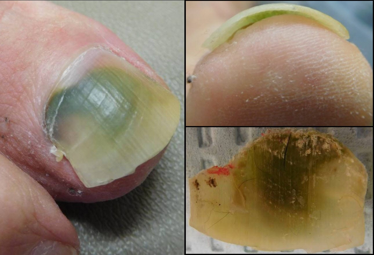 Fingernail And Toenail Abnormalities Nail The Diagnosis