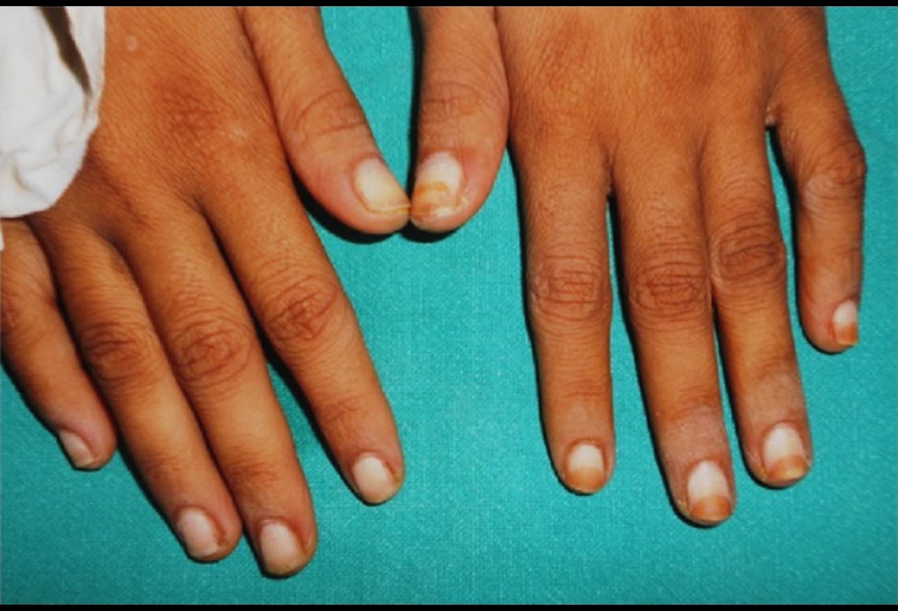 Fingernail and Toenail Abnormalities: Nail the Diagnosis