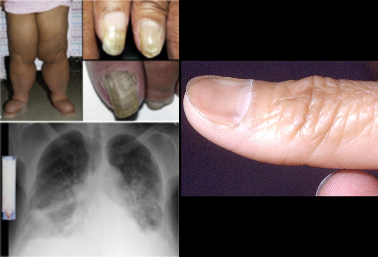 Fingernail and Toenail Abnormalities Nail the Diagnosis