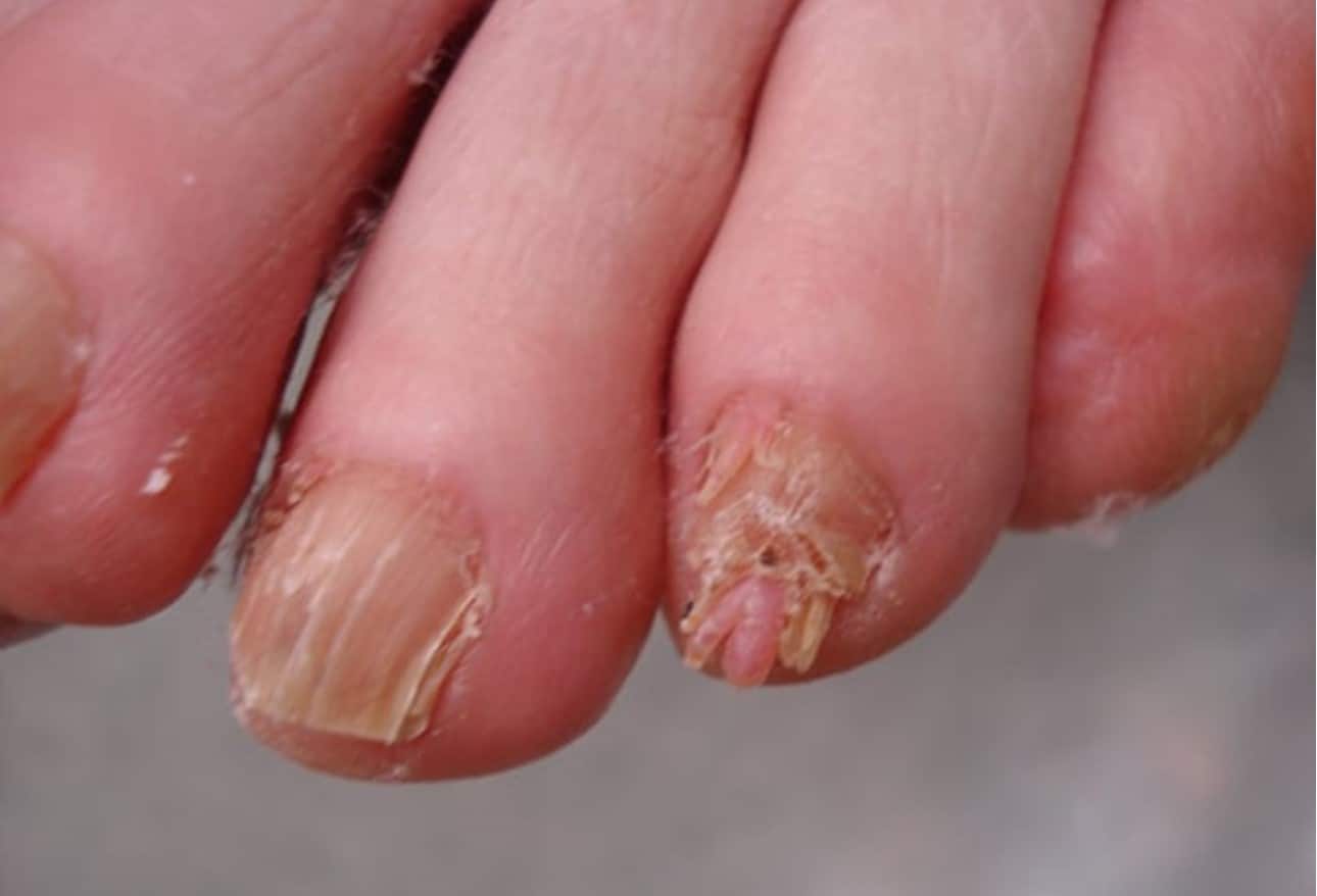 15 Fingernail and Toenail Abnormalities