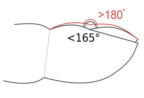 Evaluation of nail lines: Color and shape hold clues