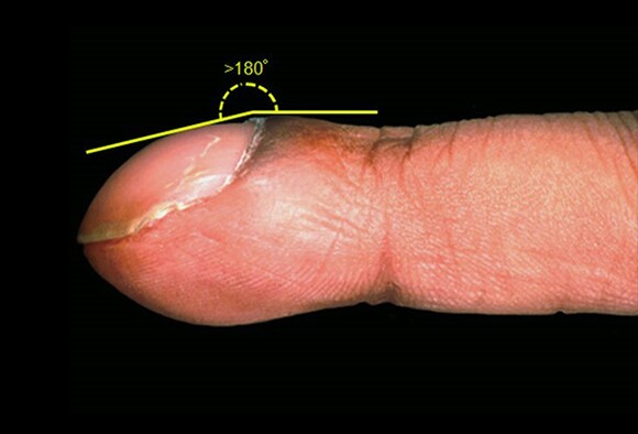 Fingernail And Toenail Abnormalities Nail The Diagnosis