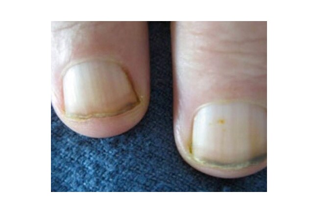 Fingernail and Toenail Abnormalities: Nail the Diagnosis