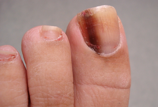 Fingernail And Toenail Abnormalities: Nail The Diagnosis