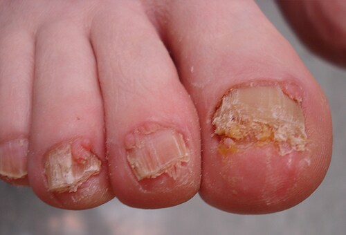 Fingernail And Toenail Abnormalities Nail The Diagnosis