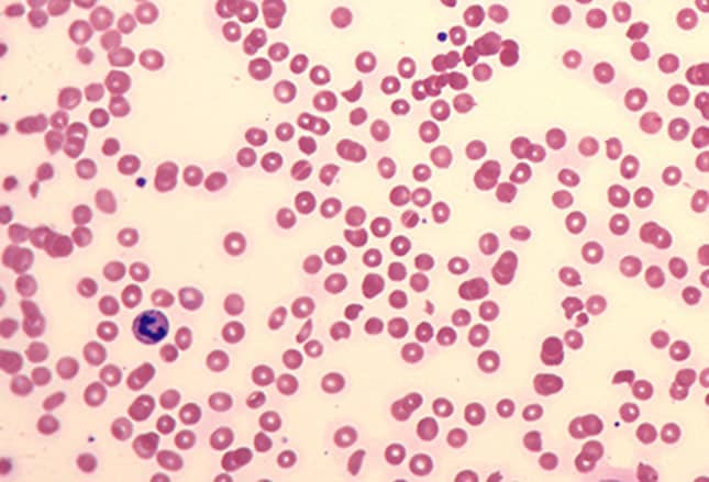 Тромбоцитоз лейкоцитоз. Schistocytes. Toxic hemolytic anemia. St. pneumoniae-associated hemolytic-uremic Syndrome.