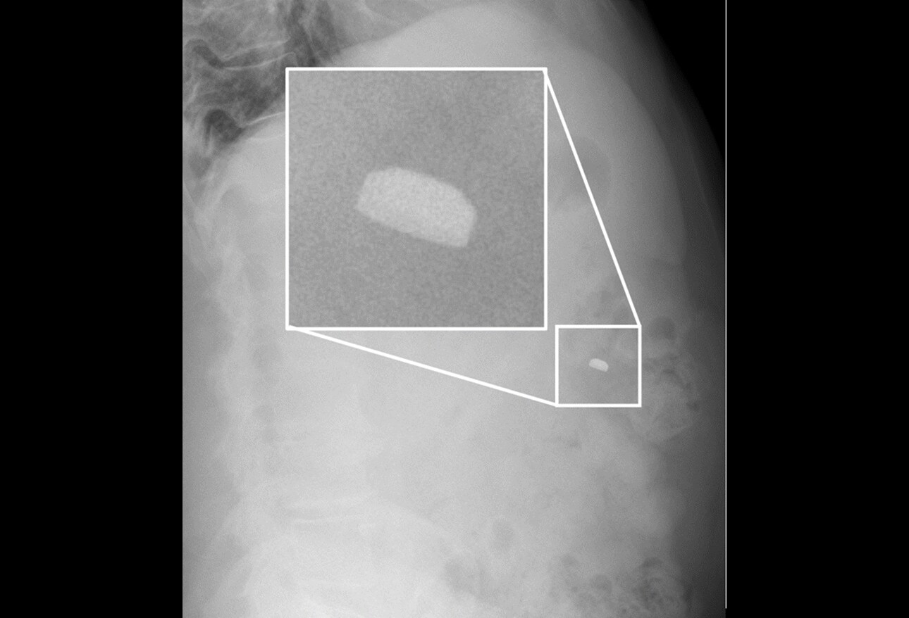 Foreign Bodies Curious Findings