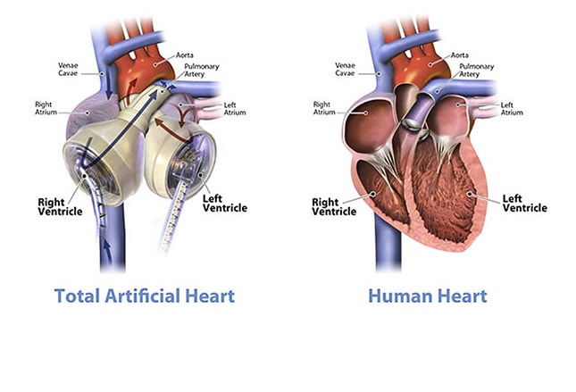 The Bionic Body 10 Cutting Edge Advances In Transplantation