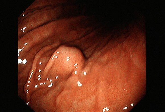 gastric cancer medscape