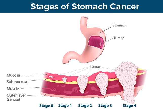 Gastric Cancer: Declining Incidence, Poor Prognosis