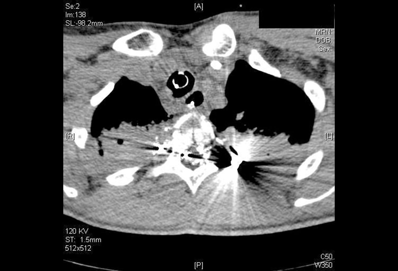 Gunshot Wounds A Targeted Approach