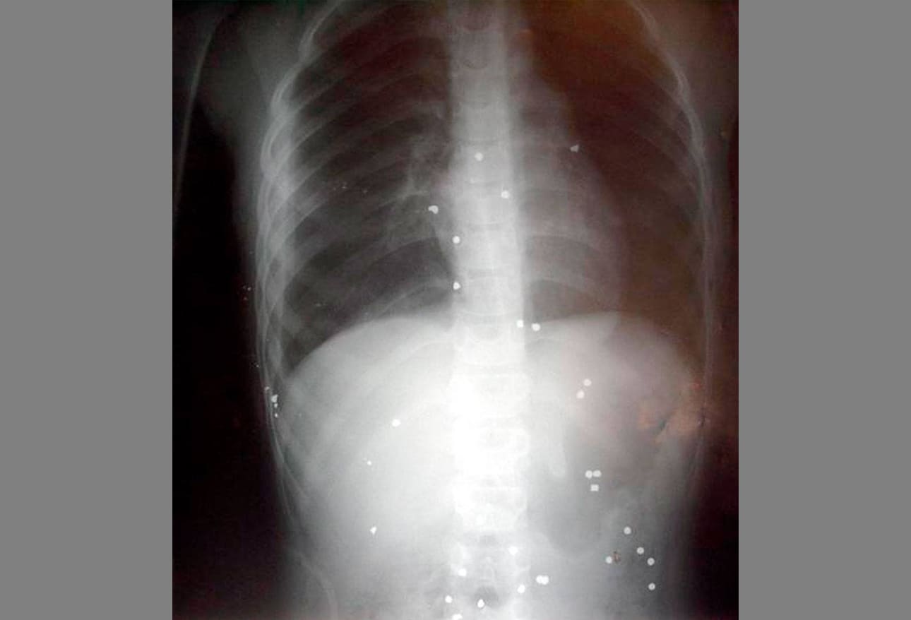 Gunshot Wounds Damage and Death