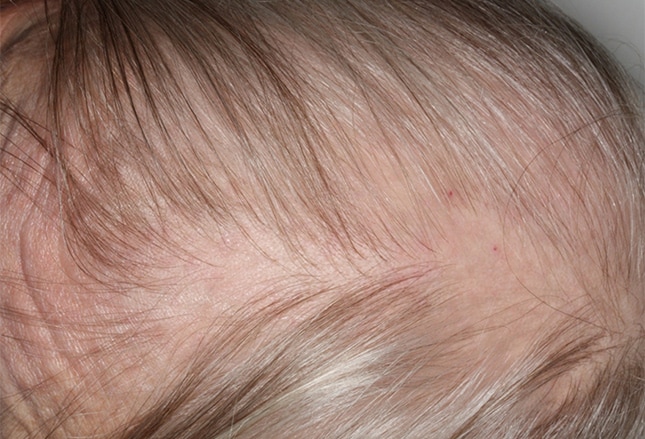 Hair loss types Alopecia areata overview