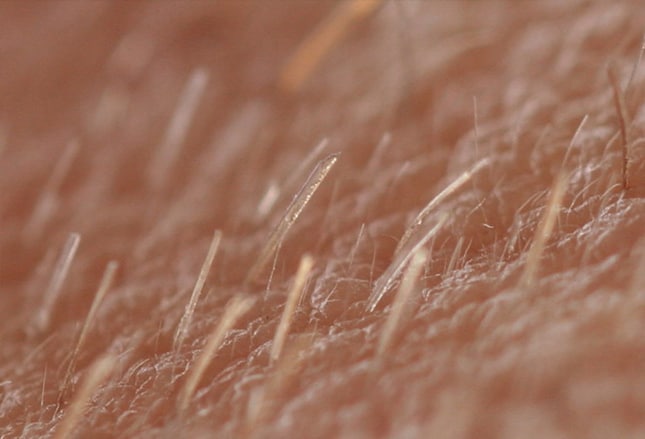 The genetics of hair shaft disorders  ScienceDirect