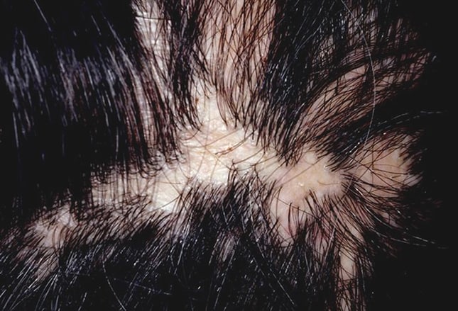 Hair Disorders: Finding the Root of the Problem