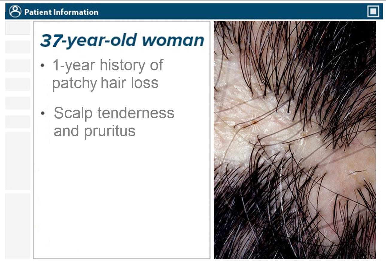 Hair Disorders Finding the Root of the Problem