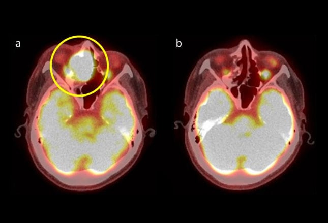 7 Head And Neck Cancers You Should Know