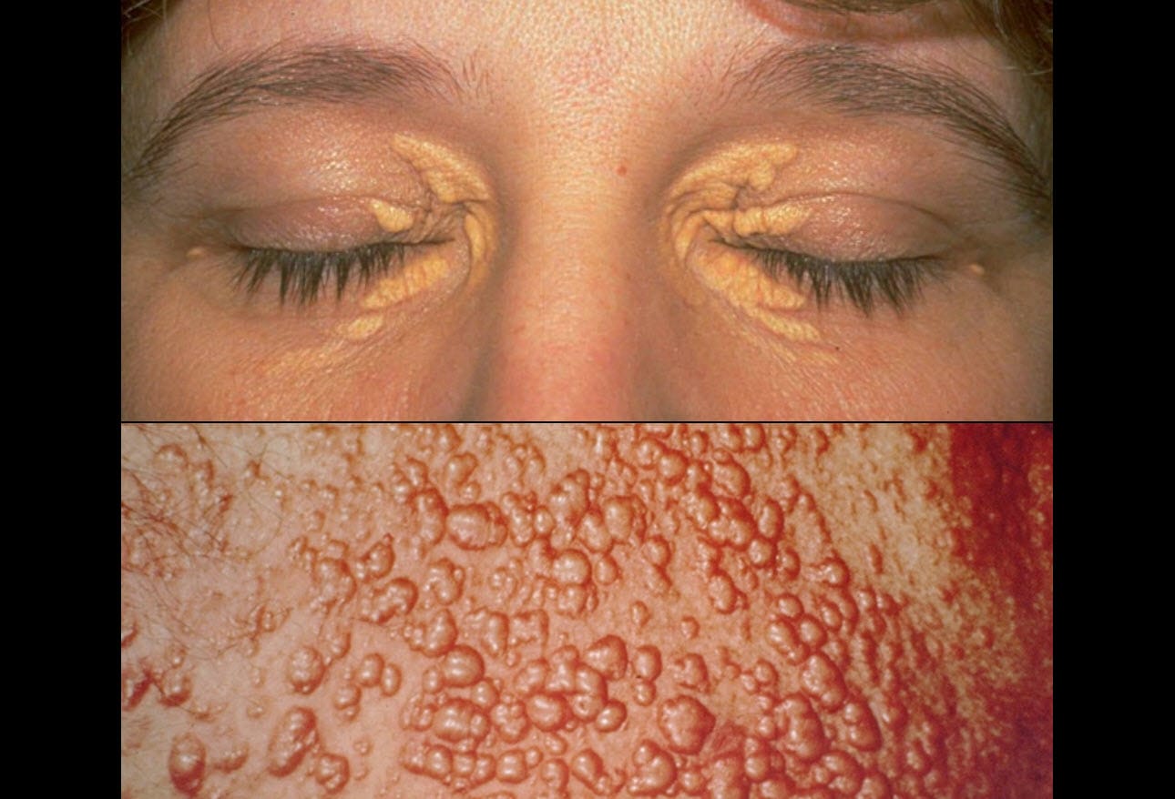Hidden Heart Disease: Dermatologic Clues You Should Know