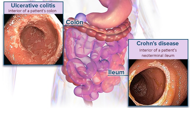Platano colon irritable