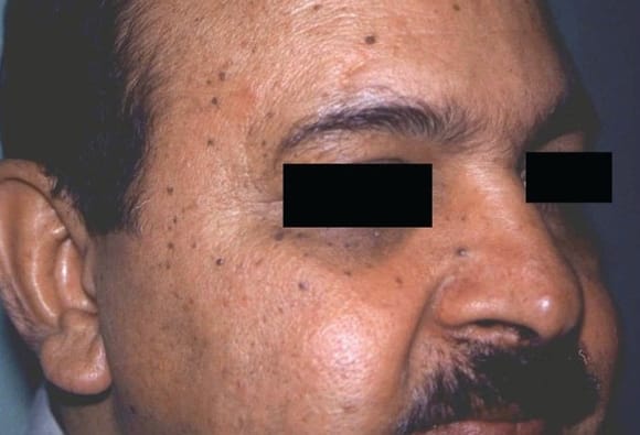 Identifying Lesions On Skin Of Color