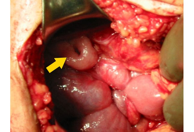 A) Anterior view of huge ulcerated mass at right breast with 32 weeks