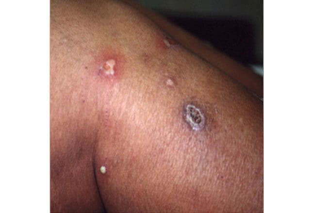 Bacterial Skin Infections: Can You Make the Diagnosis?