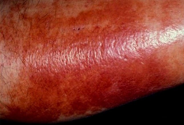 Bacterial Skin Infections Can You Make The Diagnosis
