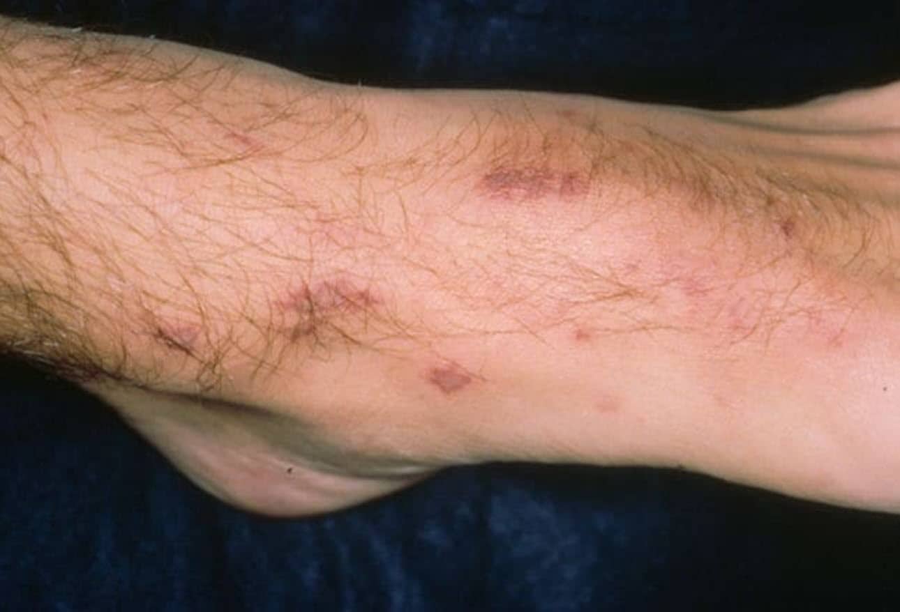 Bacterial Skin Infections Beneath the Surface
