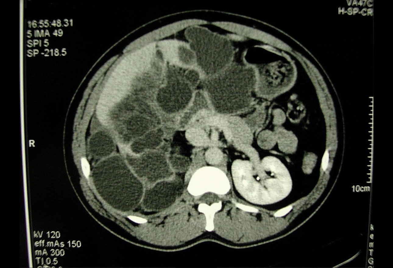 What's Eating You: 12 Common Intestinal Parasites
