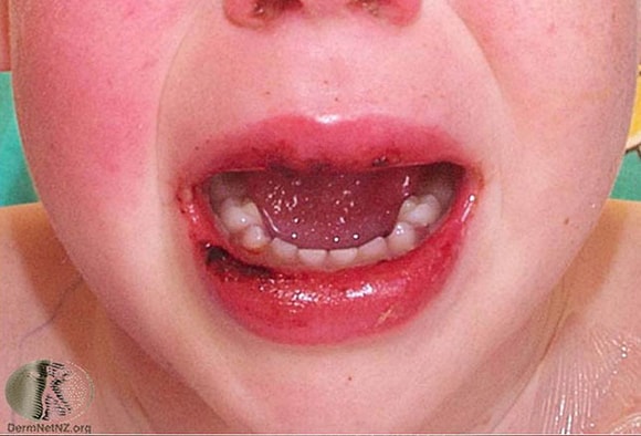 sand lidenskab Dental Kawasaki Disease: Do You Know the Signs?