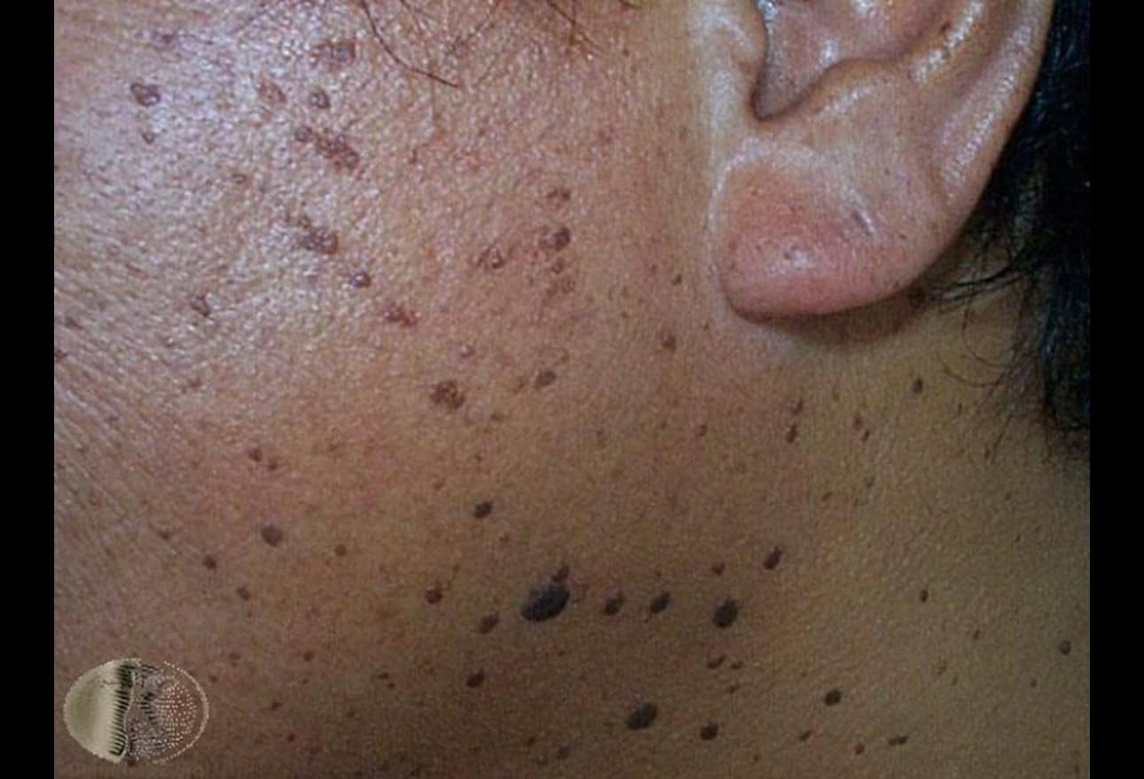 lesions-on-skin-of-color-what-you-need-to-know