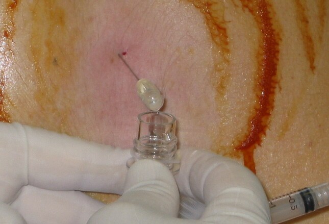 lumbar puncture pictures