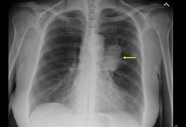 Lung Cancer Staging: Imaging Options